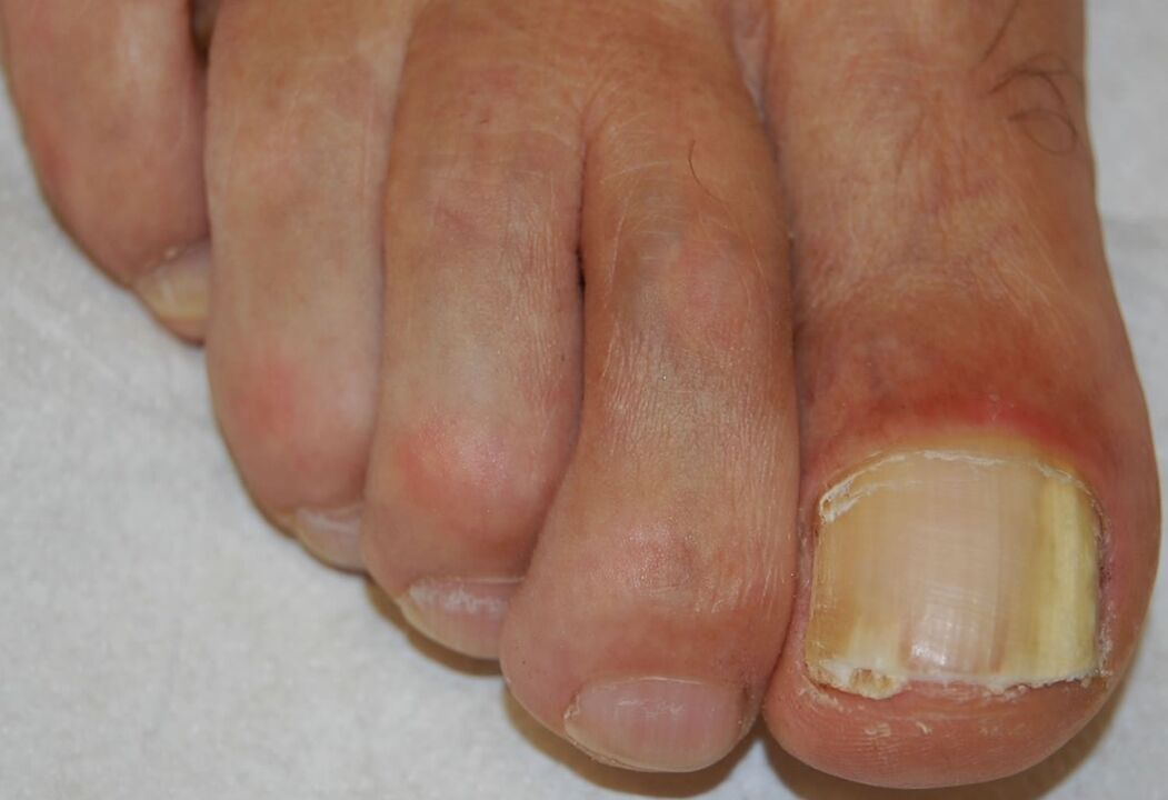 Distális-laterális subungualis onychomycosis a lábon